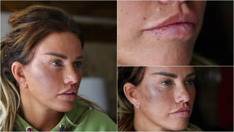  Katie Price Taken to Hospital After Brutal Attack