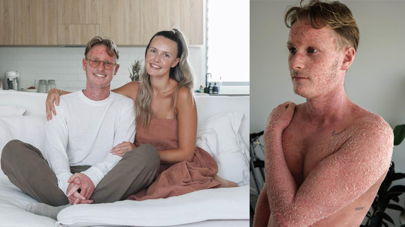  Australian eczema-sufferer left with ‘lizard skin’ after the body becomes ‘addicted’ to treatment