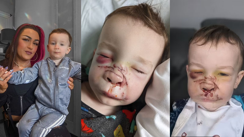  Dog attack: Mother posts heartbreaking photos of her 2-year-old son after his face ripped to shreds