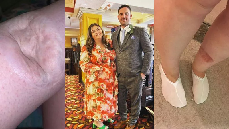  Mum Told by Doctors for 10 Years Her Rash Was ‘Just Flaky Skin’ Ends Up With Massive Crater in Leg