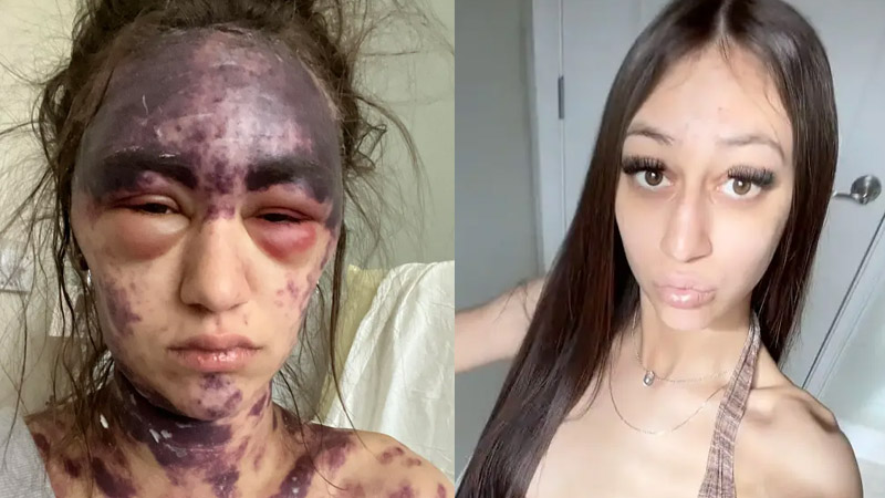 Florida Woman Blinded and Bruised